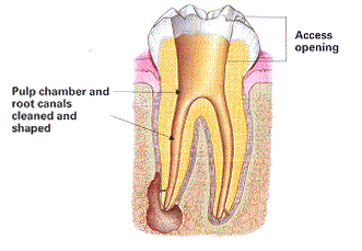 Pearl River Root Canal Surgery