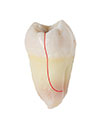 Split Tooth Treatment in Westwood