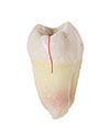 Nanuet Cracked Tooth