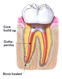 Endodontic Retreatment in Pearl River